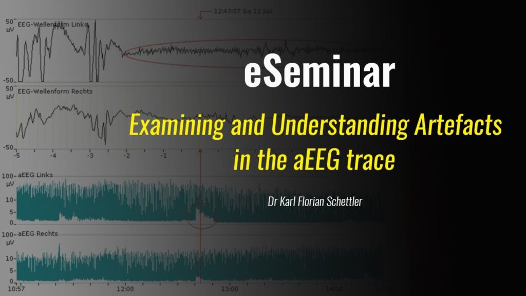 Examining and Understanding Artefacts in the aEEG trace