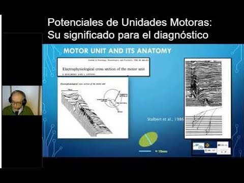 Potenciales de Unidades Motoras: Su significado para el diagnóstico