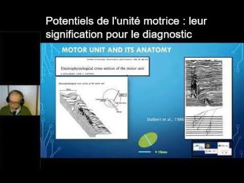 Potentiels de l'unité motrice : leur signification pour le diagnostic