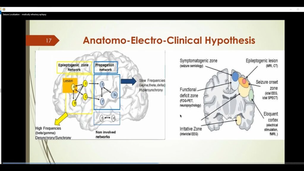 Seizure Localization: Medically refractory epilepsy