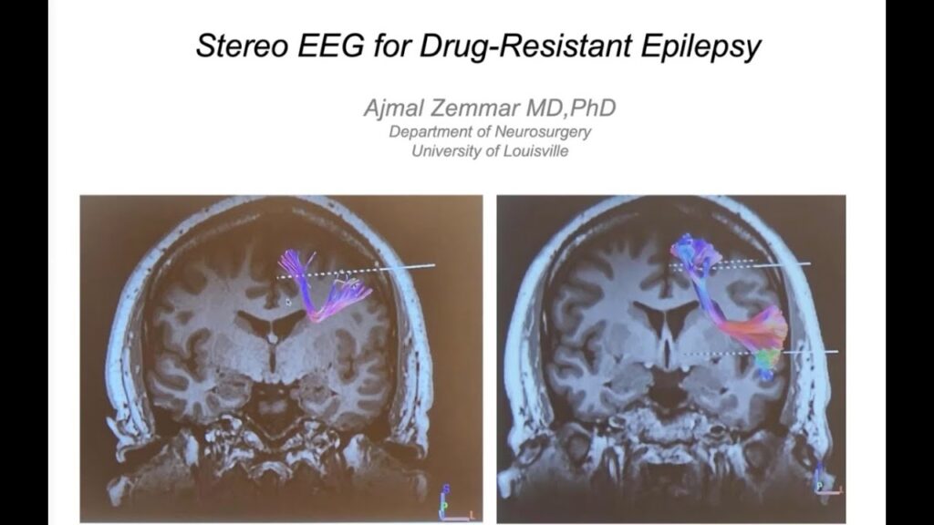 Stereoelectroencephalography (SEEG) for Drug Resistant Epilepsy
