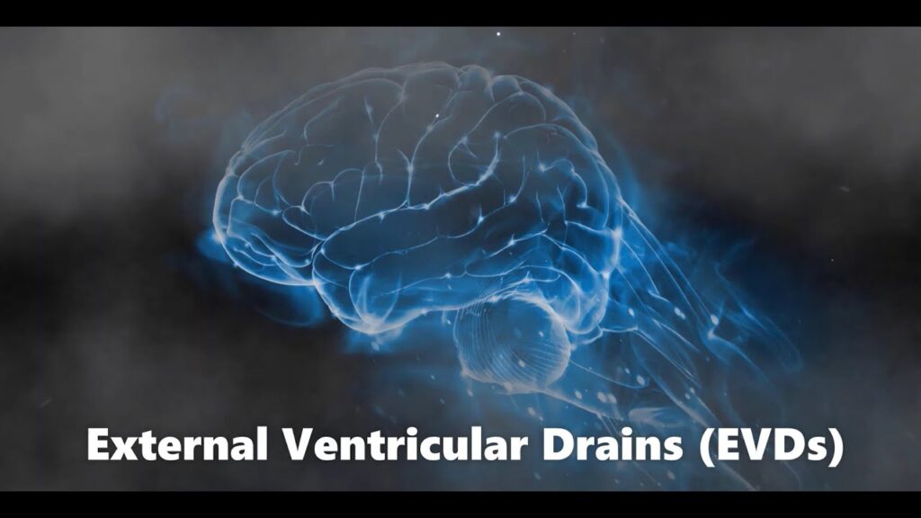 Ventriculostomy