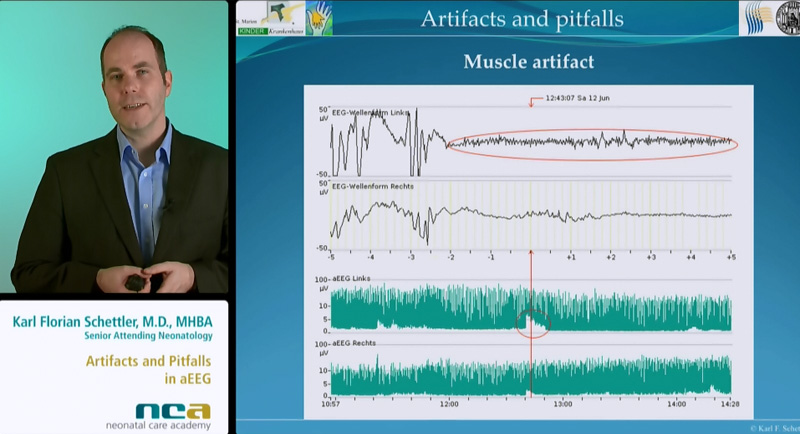 Artefacts and Pitfalls in aEEG